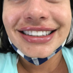 Clareamento Dental