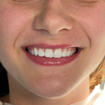 Facetas em Resina Composta