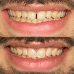 Fechamento de Diastema