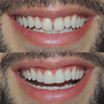 Fechamento de Diastema
